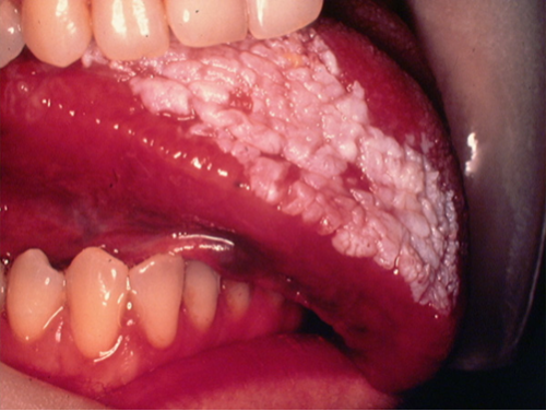 white lumps on tongue
