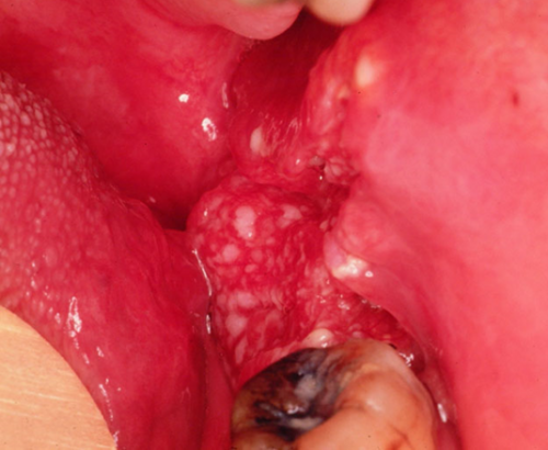 white spots at the back of mouth