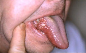 white cancerous infected tongue
