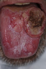 large brown growth on tongue